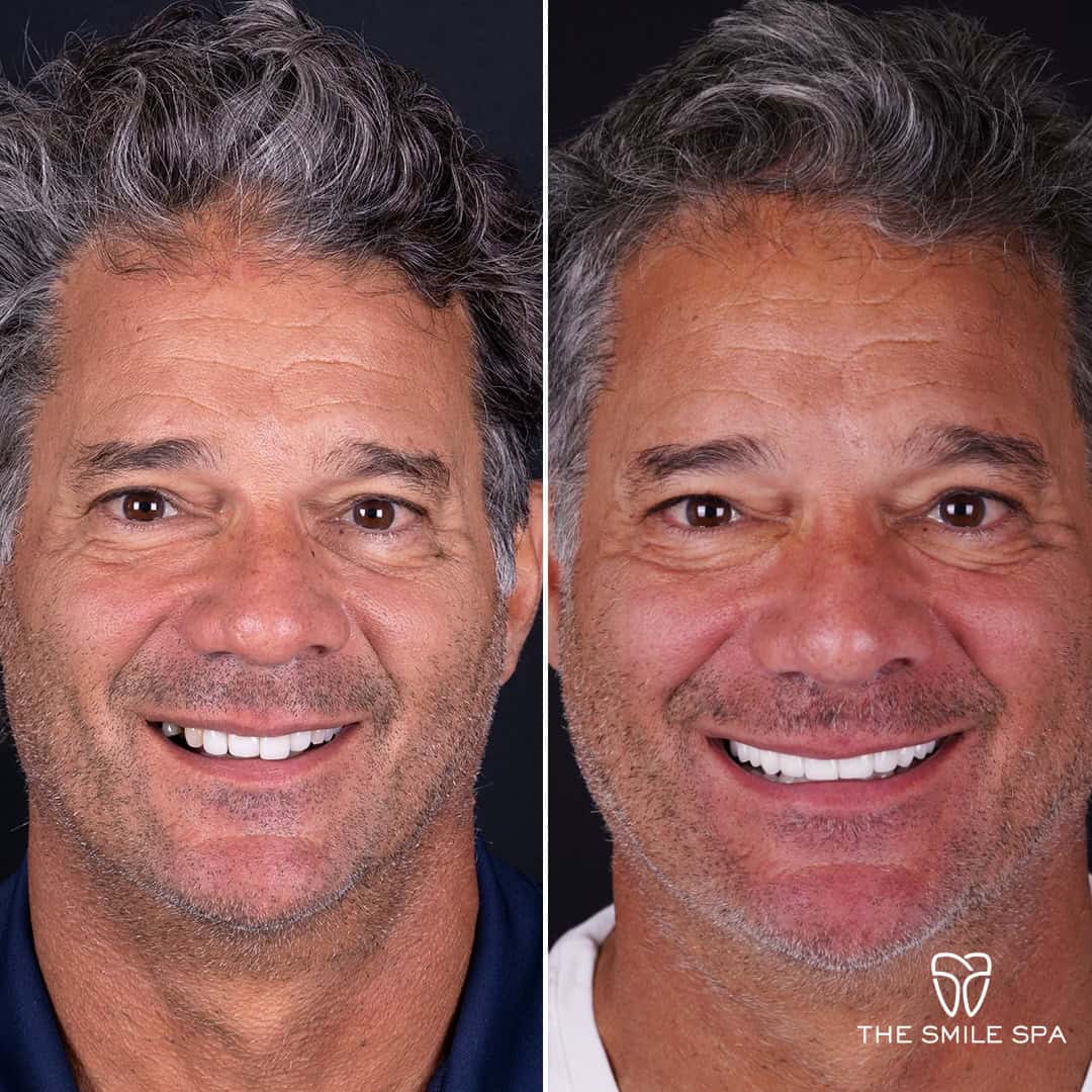Before and after smile transformation at Smile Spa Camarillo Dentistry — case 21