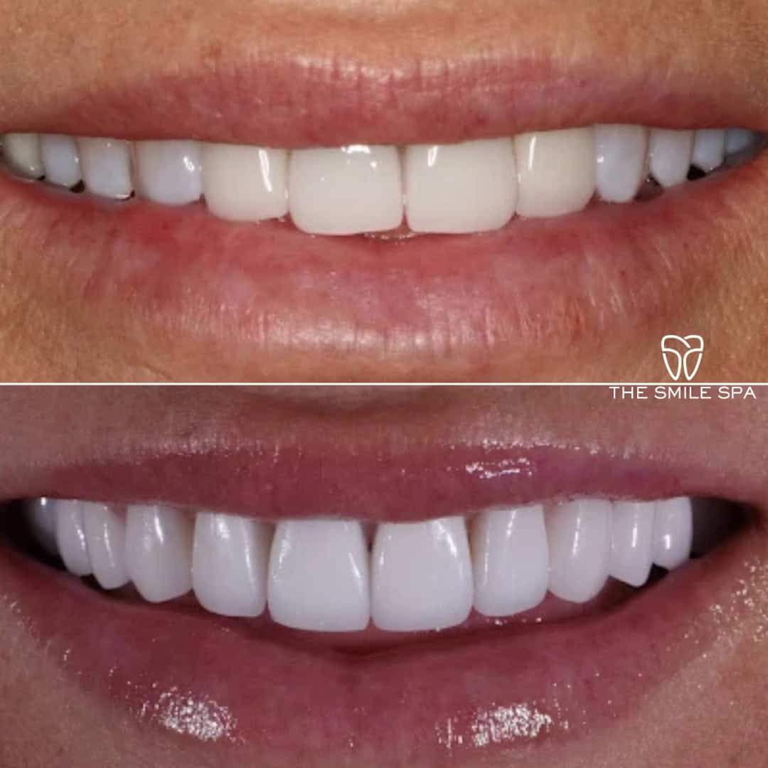 Before and after smile transformation at Smile Spa Camarillo Dentistry — case 5