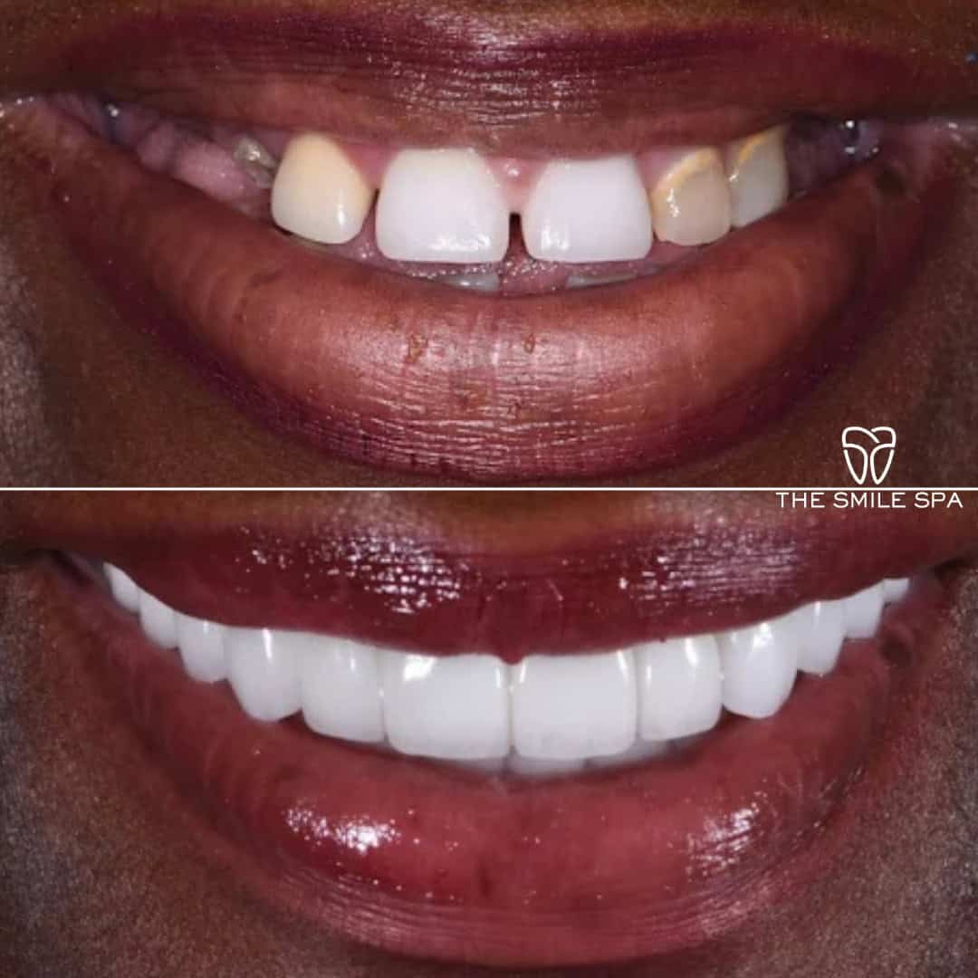 Before and after smile transformation at Smile Spa Camarillo Dentistry — case 6