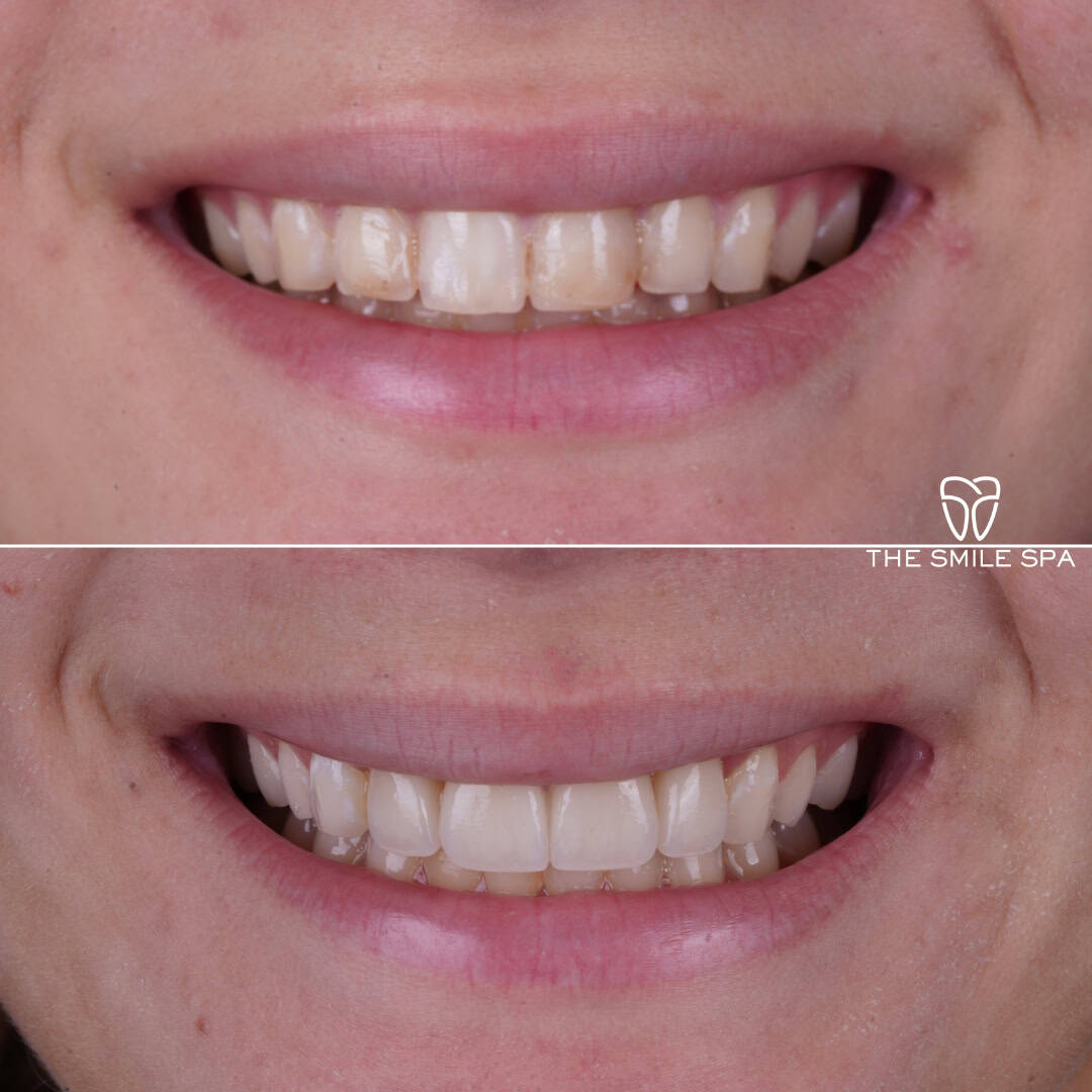 Before and after smile transformation at Smile Spa Camarillo Dentistry — case 4