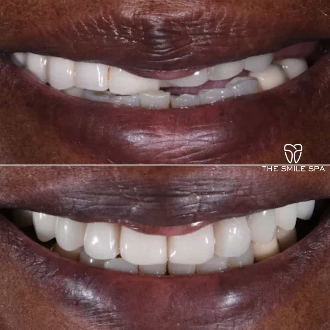 Before and after smile transformation at Smile Spa Camarillo Dentistry — case 8