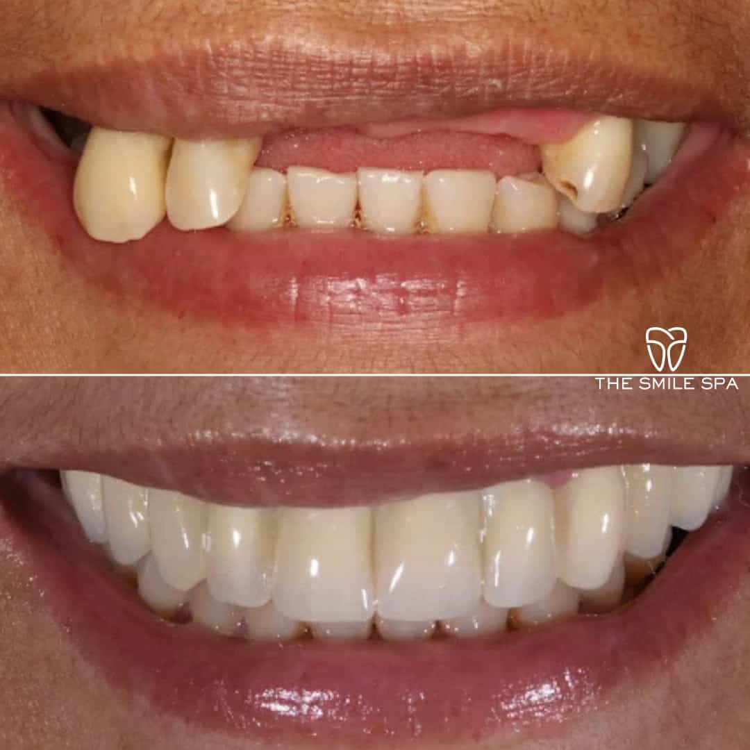 Before and after smile transformation at Smile Spa Camarillo Dentistry — case 9
