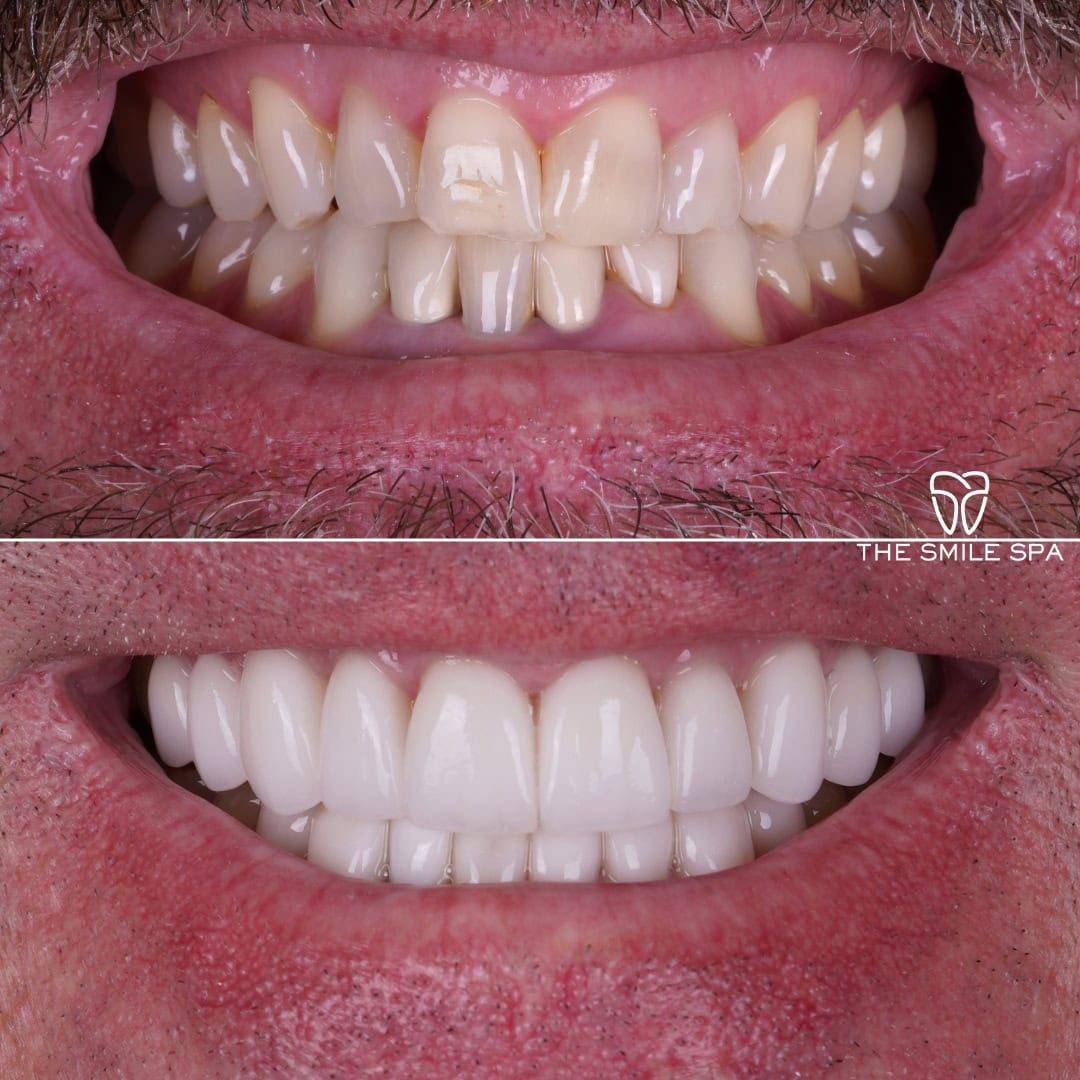 Before and after smile transformation at Smile Spa Camarillo Dentistry — case 7