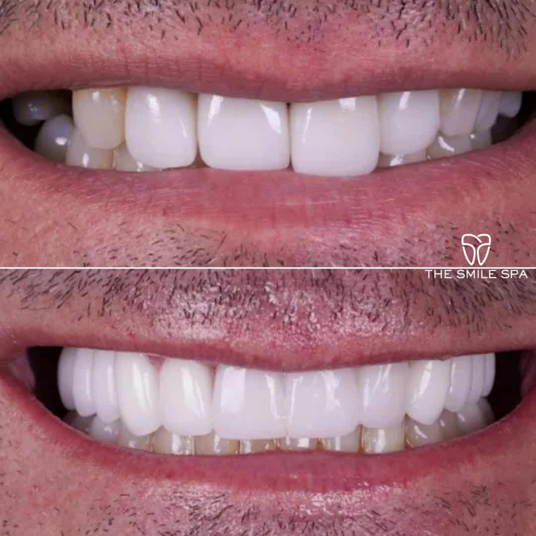 Before and after smile transformation at Smile Spa Camarillo Dentistry — case 11