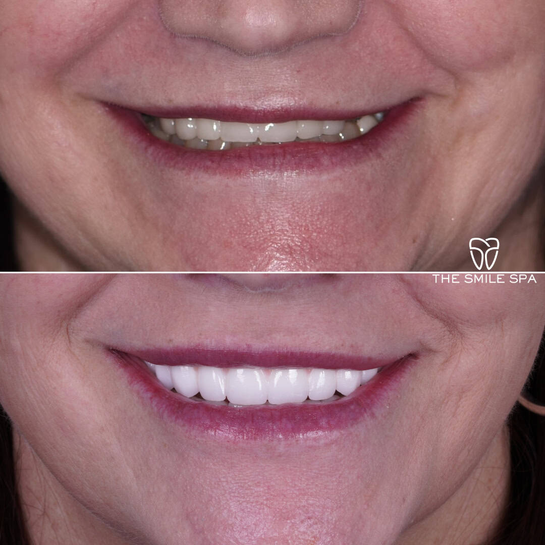 Before and after smile transformation at Smile Spa Camarillo Dentistry — case 12