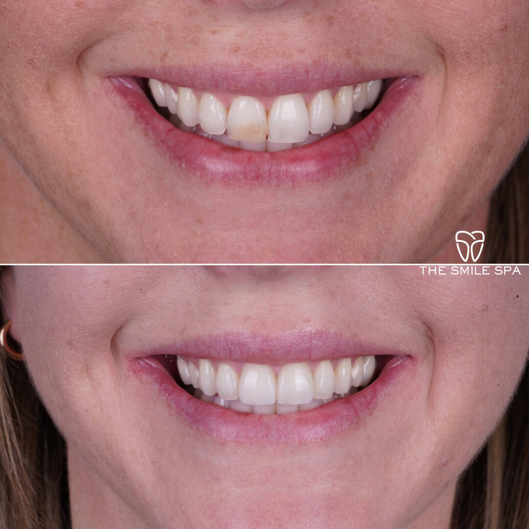 Before and after smile transformation at Smile Spa Camarillo Dentistry — case 10