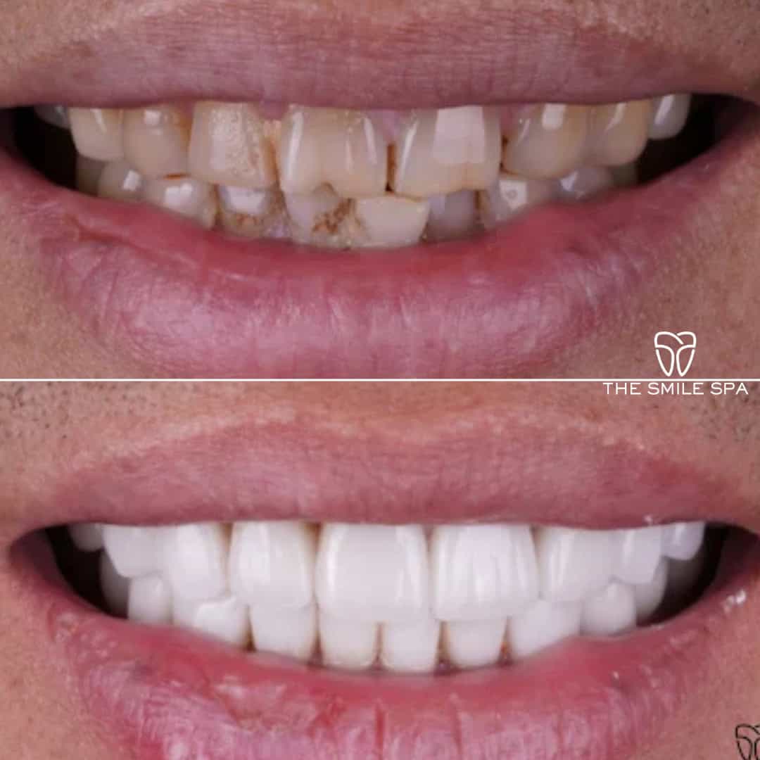 Before and after smile transformation at Smile Spa Camarillo Dentistry — case 14
