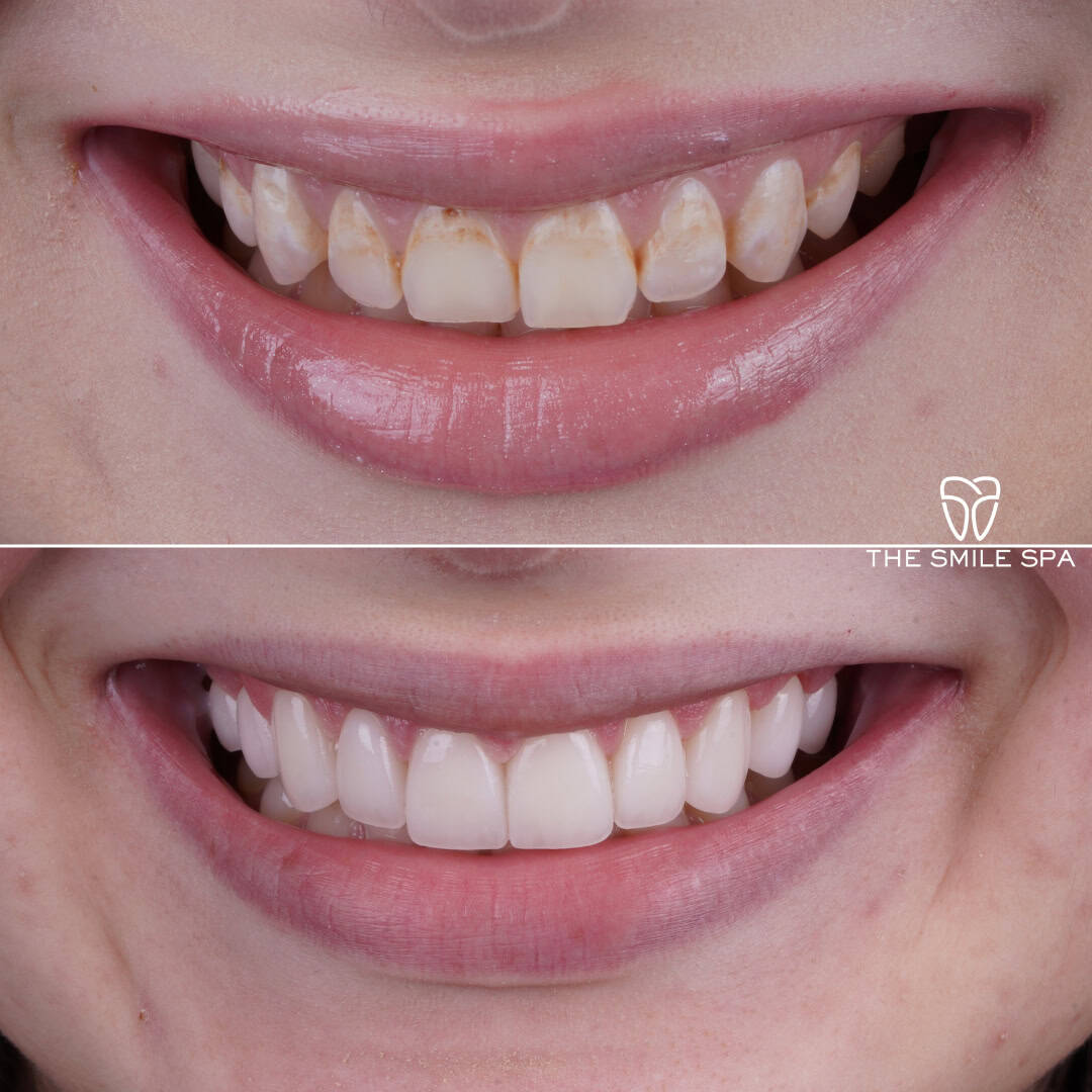 Before and after smile transformation at Smile Spa Camarillo Dentistry — case 13