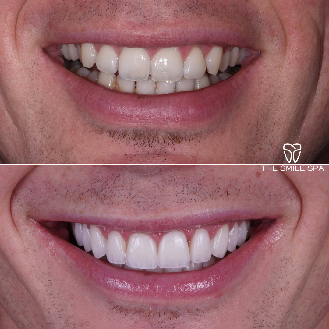 Before and after smile transformation at Smile Spa Camarillo Dentistry — case 15