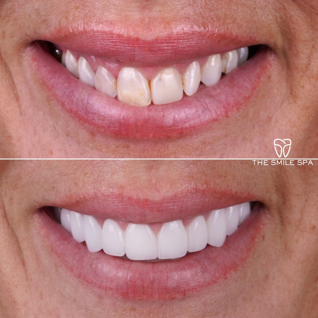 Before and after smile transformation at Smile Spa Camarillo Dentistry — case 16
