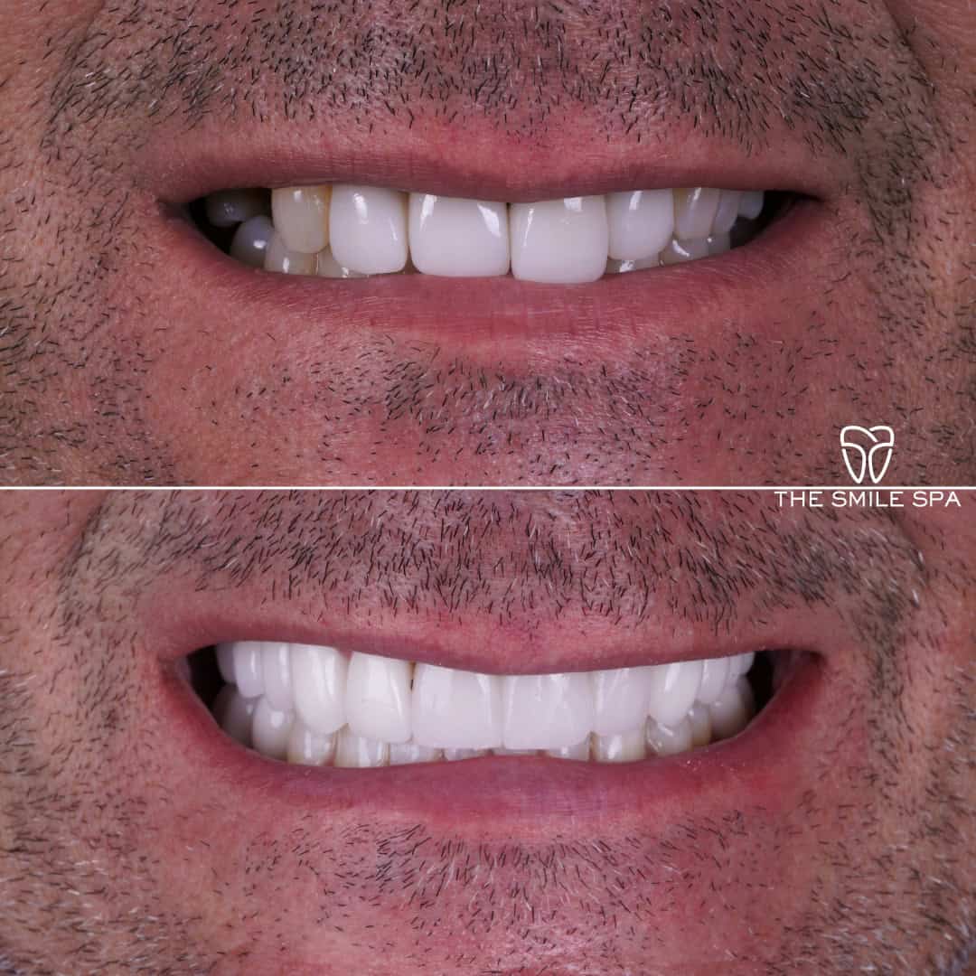 Before and after smile transformation at Smile Spa Camarillo Dentistry — case 17