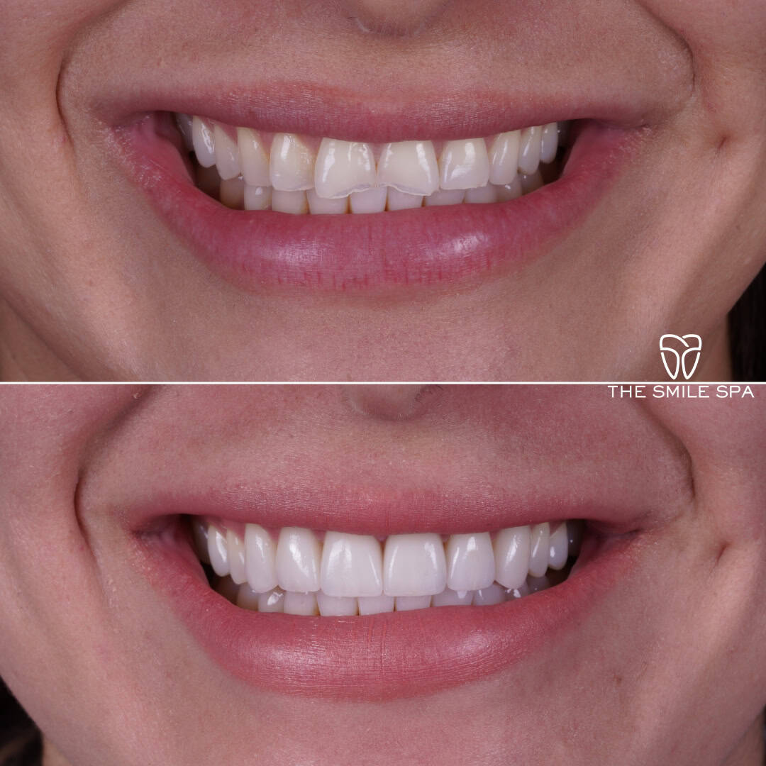 Before and after smile transformation at Smile Spa Camarillo Dentistry — case 18