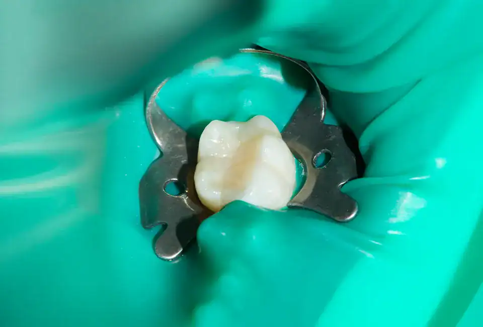 root-canal-treament (1) root canal therapy