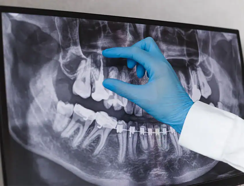 Root Canal Treatment at Smile Spa Camarillo Dentistry