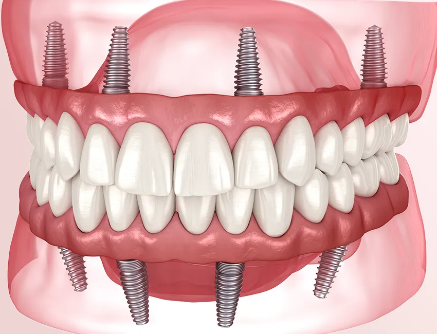 same-day-teeth.webp