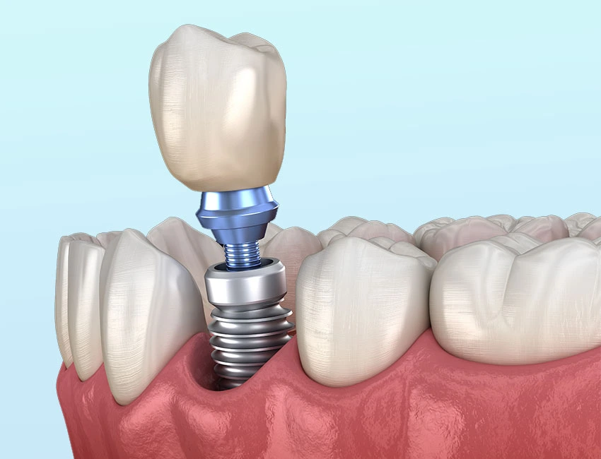 The Different Types of Dental Implants Explained