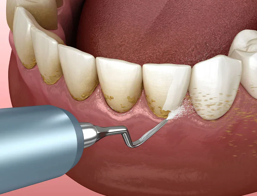 Teeth Cleaning at Smile Spa Camarillo Dentistry