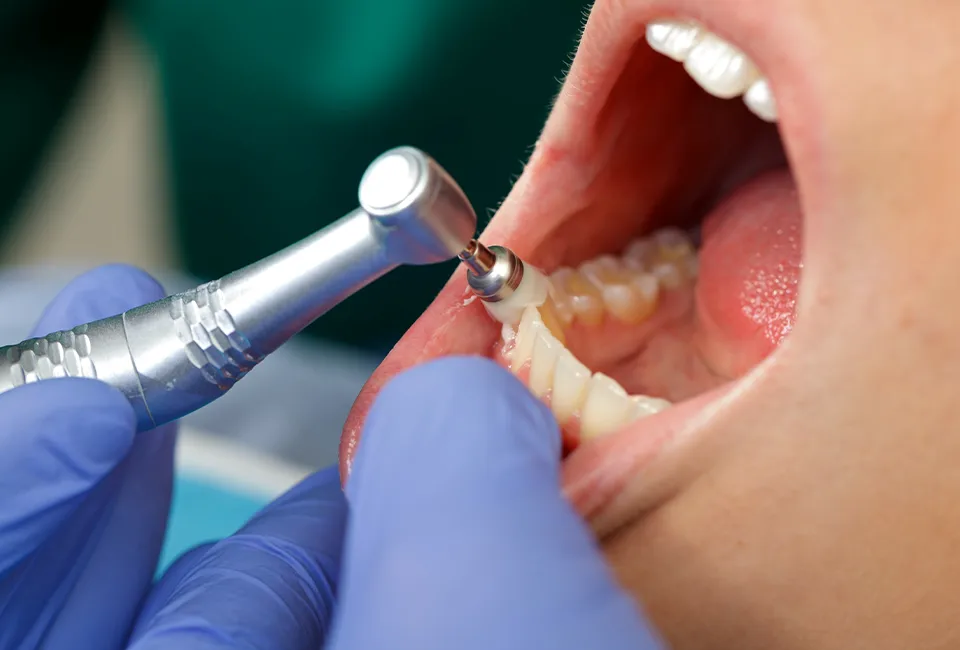 Teeth Cleaning in Camarillo, CA