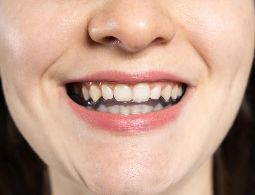 tmj-Splint-Therapy.webp