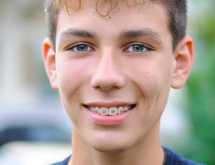 traditional-braces.webp