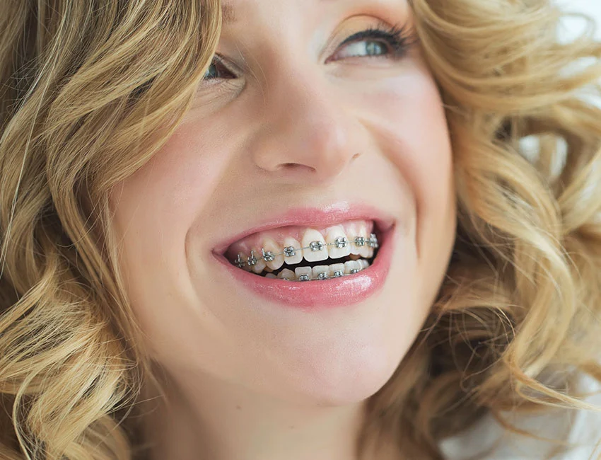 traditional-metal-braces.webp