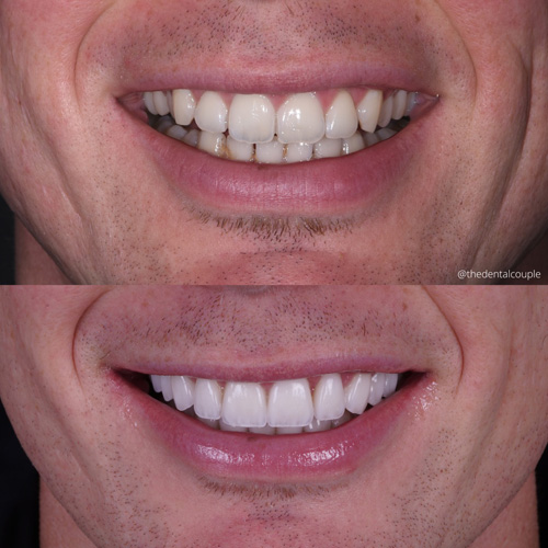 Before and after smile transformation at Smile Spa Camarillo Dentistry — case 31