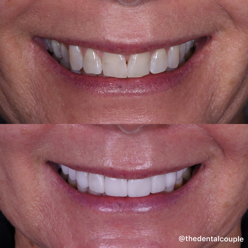 Before and after smile transformation at Smile Spa Camarillo Dentistry — case 32