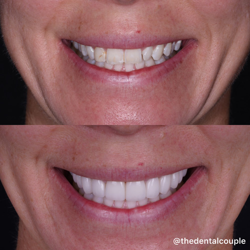 Before and after smile transformation at Smile Spa Camarillo Dentistry — case 33