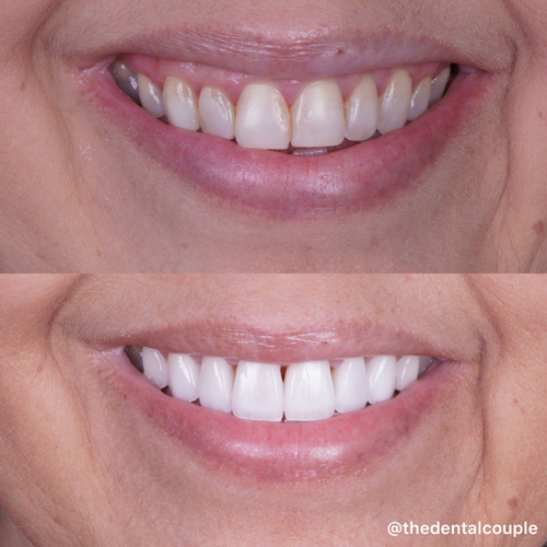 Before and after smile transformation at Smile Spa Camarillo Dentistry — case 34
