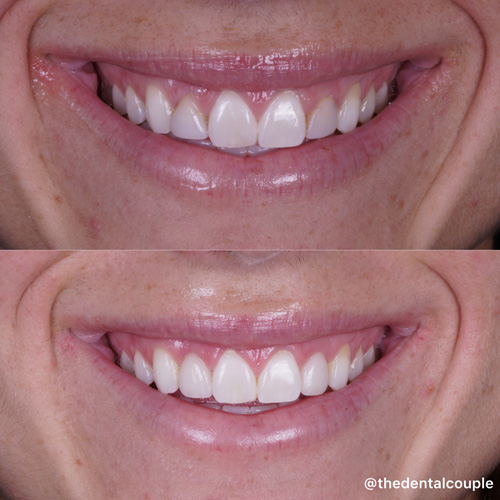 veneers-image5.jpg