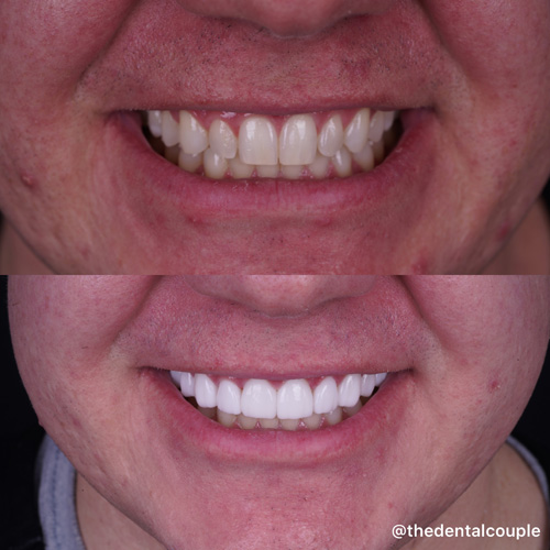 Before and after smile transformation at Smile Spa Camarillo Dentistry — case 35