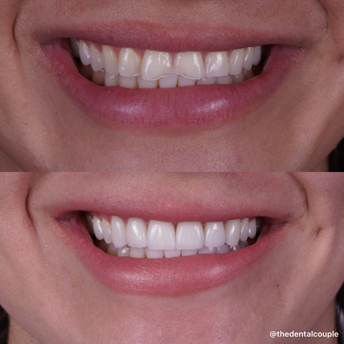 Before and after smile transformation at Smile Spa Camarillo Dentistry — case 36