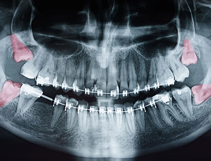 x-ray-wisdom-teeth.webp